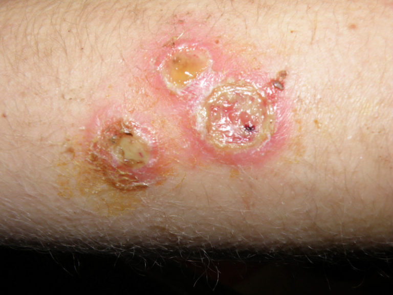 Staph Infection After A Burn 768x576 