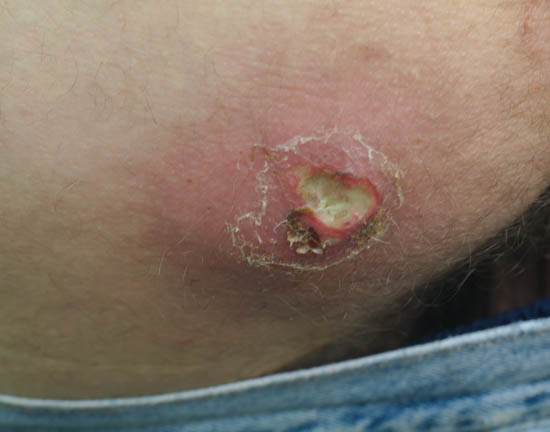 What is the Difference Between Spider Bite and Staph Infection